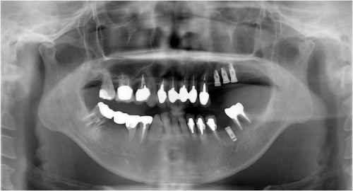 杉山３　埋入時